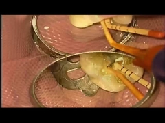 एसएएनआई उपचार मामला